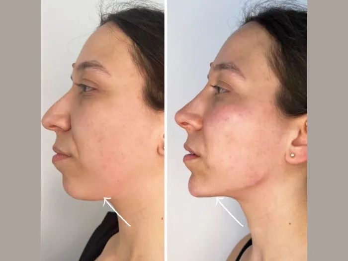 Experience Facial Rejuvenation through Advanced Endolift Treatment in Dubai